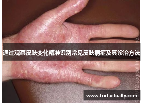 通过观察皮肤变化精准识别常见皮肤病症及其诊治方法